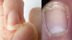  Issues Common Nail