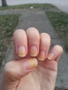 Yellowing Nails