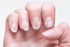 Nail Disorders