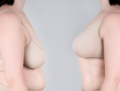 Breast Augmentation: Planning for Long-Term Breast Symmetry