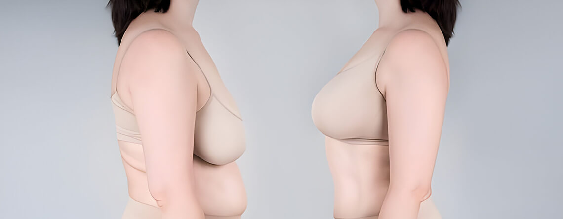 Breast Augmentation: Planning for Long-Term Breast Symmetry