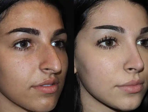 Before and After: Rhinoplasty Results in Dubai