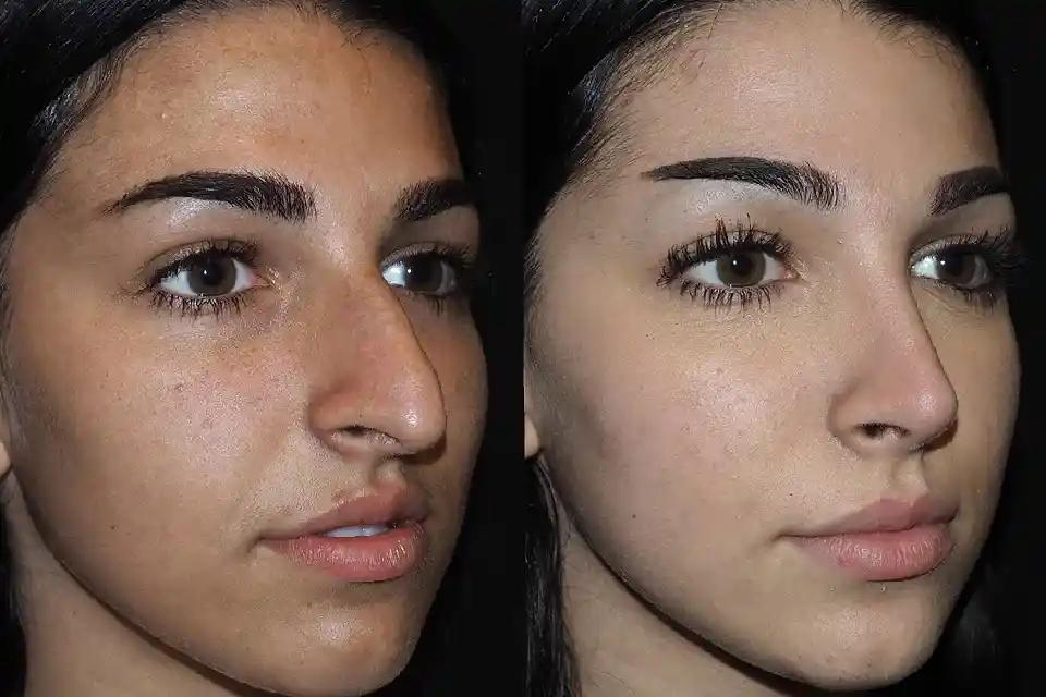 Before and After: Rhinoplasty Results in Dubai