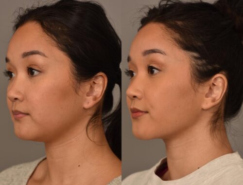 Buccal Fat Removal