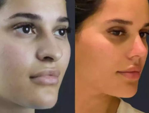 How Long Do Rhinoplasty Results Last?