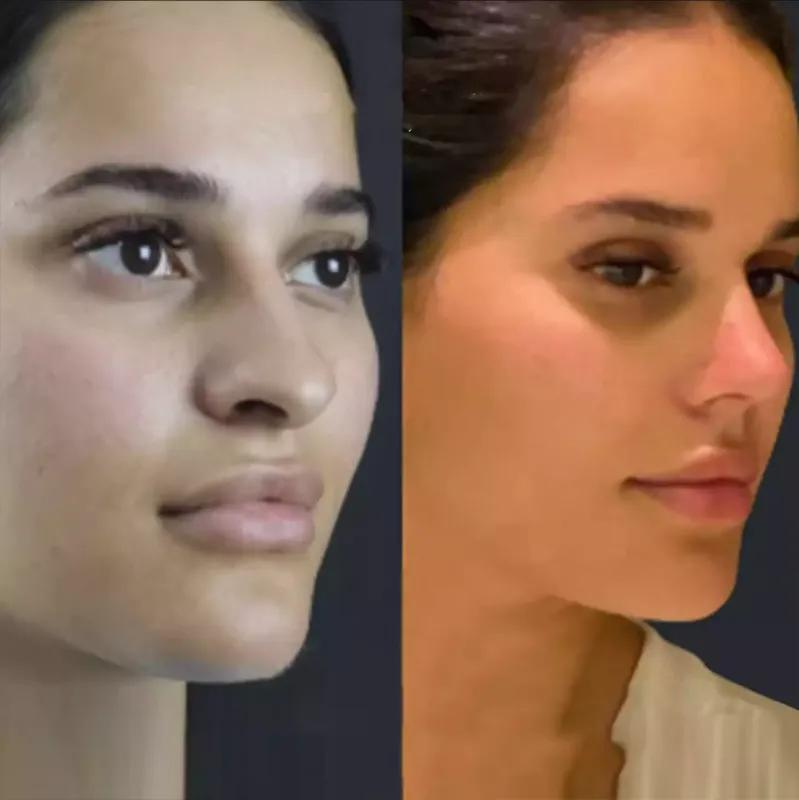 How Long Do Rhinoplasty Results Last?