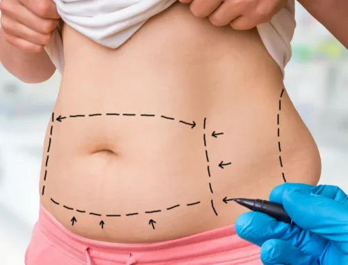 Liposuction In Dubai Perfect Doctors