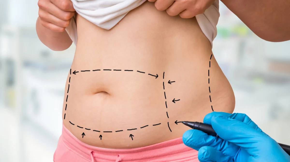 Liposuction In Dubai Perfect Doctors