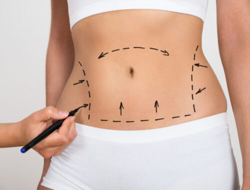 Liposuction Surgery in Dubai