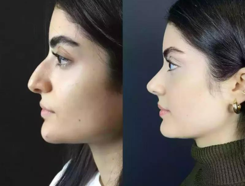 What Is the Recovery Timeline for Rhinoplasty?