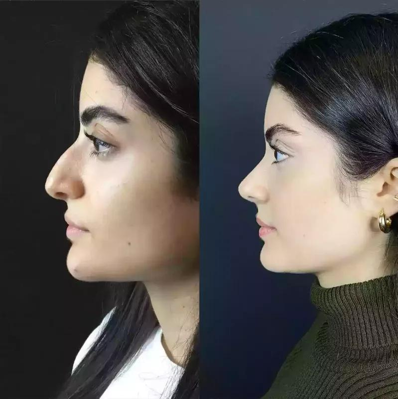 What Is the Recovery Timeline for Rhinoplasty?