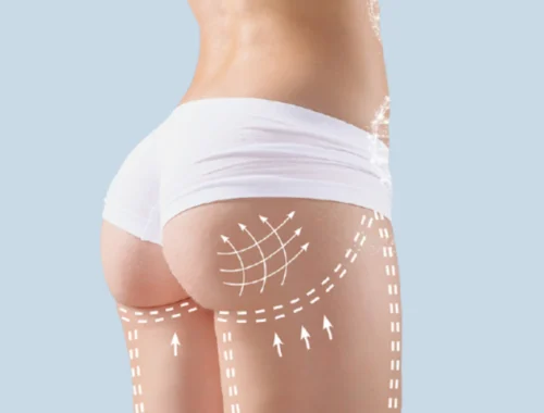 Finding the Best Aesthetic Clinic in Dubai for Butt Fillers: A Comprehensive Guide