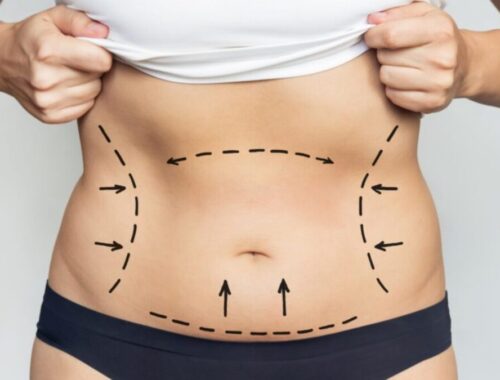 Liposuction in Dubai