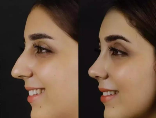 Find the Best Septoplasty Surgeon in Dubai for Perfect Results