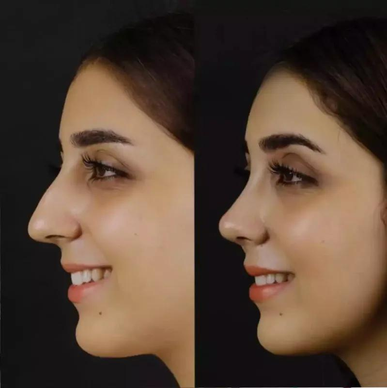 Find the Best Septoplasty Surgeon in Dubai for Perfect Results