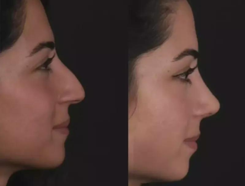 The Best Rhinoplasty Surgeon in Dubai: What Sets Them Apart