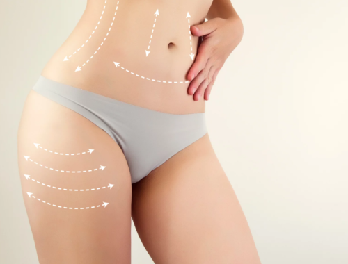 Best Liposuction Surgery Cost in Dubai