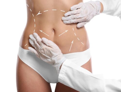 How to Prepare Your Questions for the Best Full Body Liposuction Surgeons in Dubai